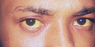 Penyakit yang dikenal dengan nama penyakit kuning ini disebut demikian karena biasanya kulit & bagian putih pada mata penderita akan berwarna kekuningan. Penyakit Kuning Disebabkan Oleh Zat Bilirubin Kenali Gejala Dan Cara Pencegahannya Merdeka Com