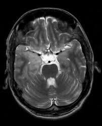 Limbic encephalitis, mca ischaemia, tumours, effects of seizures) hyperintense t2 signal in the medial temporal lobes, inferior frontal lobes and insula basal ganglia are usually spared Varicella Zoster Encephalitis Wikidoc