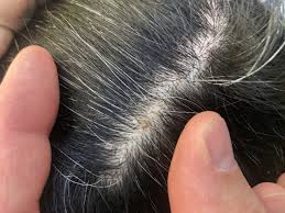 I do not have the follo answered by dr. Tender Scalp Melanoma