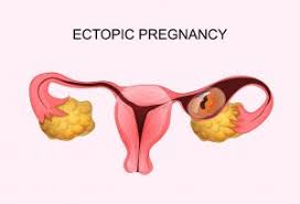 Abdominal Pain During Pregnancy Causes Signs Treatments