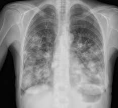 Signs of tumor in the colon of the intestine are quite insignificant at the initial stage. Pulmonary Metastases Colon Cancer Radiology Case Radiopaedia Org