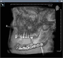 Being told that your child has cancer is extremely difficult. Oral Cancer Wikipedia