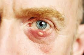 Image result for milium cyst on eyelid