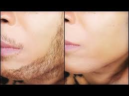 This is the only treatment modality available that can permanently. 12 How To Remove Facial Hair Permanently With Just 3 Ingredients Khich How To Remove Facial Hair Unwanted Facial Hair How To Remove Facial Hair Permanently