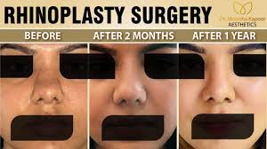 Perfect Rhinoplasty Result After 1 Year In 2020 Rhinoplasty Surgery Rhinoplasty Facial Aesthetics