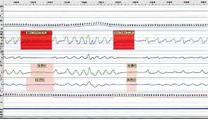 Appareil pour apnée du sommeil. Apnee Du Sommeil Pathophysiologie Signes Et Symptomes Dr Sylvain Chamberland Orthodontiste