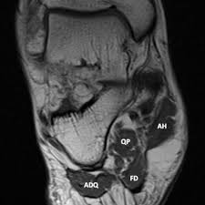 Routine ankle magnetic resonance imaging (mri) tests involve taking images of the foot the mri machine uses radio wave energy pulses and a magnetic field to produce the foot and ankle images. Baxter 039 S Neuropathy Isolated Fatty Atrophy Of The Abductor Digiti Minimi Muscle In Association With Plantar Fasciitis Eurorad