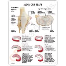 Complex Meniscus Tear Bing Images Meniscus Tear Knee Injury Physical Therapy Exercises