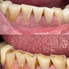 Image result for Tooth Attrition