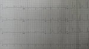 A diagnosis may be supported by an electrocardiogram (ecg), increased troponin, heart mri, and occasionally a heart biopsy. Pericarditis Wikipedia La Enciclopedia Libre
