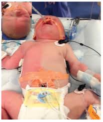 Franceschetti zwahlen klein syndrome ver síndrome de franceschetti … diccionario de oftalmología. Maladies Rares En Pediatrie
