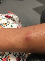 Libre pour usage commercial ✓ pas d'attribution requise ✓. Piqures D Insectes Reveil Araignee Picture Of Kiani Akti Porto Rafti Tripadvisor