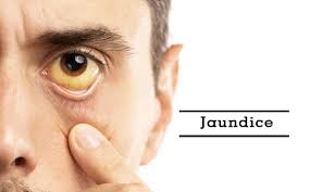 Jaundice Symptoms - Causes, Diagnosis & Treatment | Max Lab
