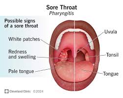 Image result for Strep throat infection roof of mouth