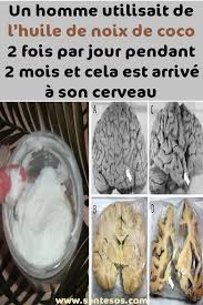 Un Homme Utilisait De L Huile De Noix De Coco 2 Fois Par Jour Pendant 2 Mois Et Cela Est Arrive A Son Cerveau Huiledenoixdecoc Health And Beauty Coco Nutrition
