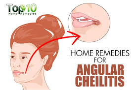 Home Remedies For Angular Cheilitis Cracked Mouth Corners Top 10 Home Remedies Cracked Corners Of Mouth Mouth Sores Top 10 Home Remedies