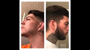 Minoxidil before and after beard result. Minoxidil For Beard Growth How To Get The Best Results