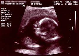 Get your free tamil jathagam in a few quick steps. Obstetric Ultrasonography Wikipedia
