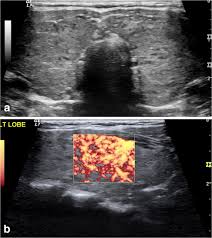 The vascularity on the ultrasound was unremarkable, typically in thyroiditis this is a low. Figure 9 Pediatric Thyroid Ultrasound A Radiologist S Checklist Springerlink