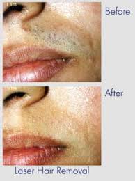 With laser hair removal at ideal image, you can say goodbye to unwanted hair on your upper lip, chin and neck, and say hello to your ideal skin™. 8 Laser Hair Removal Ideas Laser Hair Removal Hair Removal Laser Hair