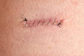 The other places may vary in case of the ideal time of leaving the stitches in : Can You Use Body Wash On Your Hair Skin Care Geeks