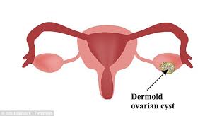 Check spelling or type a new query. Calle Hack Finds Cyst With Hair And Teeth Was Caused Her Period Pain Daily Mail Online