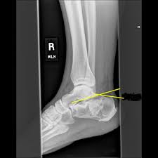Image result for Calcaneus Compression Fracture