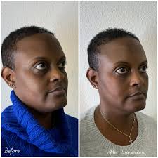 BEST of Ellicott City, MD Laser Hair Removal