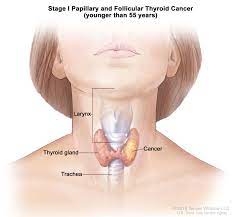 To do this, the doctor will put a thin, hollow needle right into the nodule to take out some cells and a few drops of fluid to test for cancer. Endocrine Surgery Thyroid Cancer