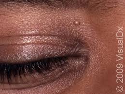 Image result for milium cyst on eyelid