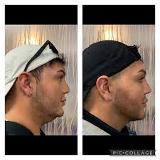 Neck/Chin Liposuction Albuquerque NM, D. Eric Tuggle, D.D.S.