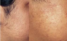 £85 for the upper lip Laser Hair Removal Patel Plastic Surgery Bck Patel Md