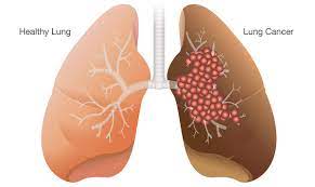 The presence of these symptoms doesn't definitively mean you have lung cancer, though, as they can also be caused by other conditions. Even Non Smokers Can Get Lung Cancer University Of Utah Health