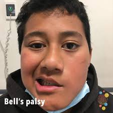 Bell palsy is a diagnosis of exclusion. Bell S Palsy Skin Deep