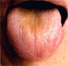 Dicker Oliger Gelber Zungenbelag Zungendiagnose Zunge Zahne Korper