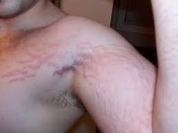 Top 3 Stretch Mark Removal Remedies Easy And Fast Stretch Mark Removal Remedies Stretch Marks Health And Beauty Tips