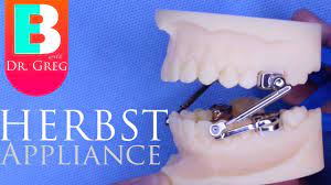 Braces Explained Herbst Appliance Youtube