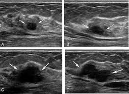 How does breast cancer look like? Breast Ultrasound Images For A 46 Year Old Woman With An Invasive Download Scientific Diagram