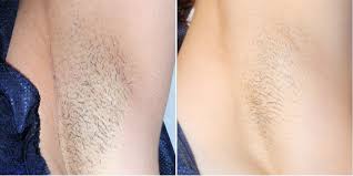 What are the recommended treatment intervals? Laser Hair Removal Ottawa Avantia Health