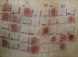 The symptoms range from redness and itching to anaphylaxis in rare cases. Indian Journal Of Dermatology Venereology And Leprology Patch Tests With Commercial Hair Dye Products In Patients With Allergic Contact Dermatitis To Para Phenylenediamine