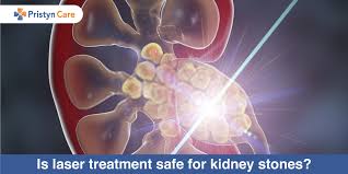 Is Laser Treatment Safe For Kidney Stones Pristyn Care