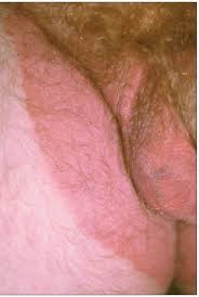 The expert medical guidance of a. How Do You Explain This Persistent Itchy Eruption Patient Care Online