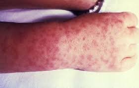 Petechial rash in children petechiae are tiny red or purple dots that usually appear on the body and in the mucus membrane. Rashes In Children Children S Hospital Colorado