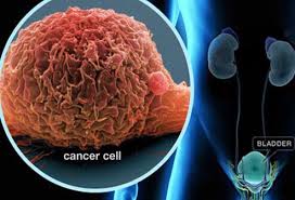 Although the incidence of bladder cancer has reduced in recent years. Bladder Cancer Symptoms Stages Treatment