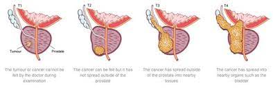 In practice, though, prostate cancer metastasis occurs most often in the lymph nodes and the bones. Prostate Cancer Treatment Symptoms Causes Diagnosis