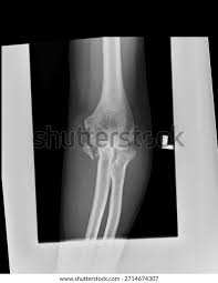 Image result for Elbow XRay