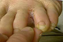 Dan kabar buruknya adalah bahwa kutu atau kuman air ini tak hanya kulit kaki maupun tangan dapat terlihat retak atau mengelupas padahal tidak tergores benda tajam apapun. Kaki Makan Air Wikipedia Bahasa Melayu Ensiklopedia Bebas