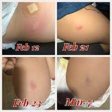Safety of varicella vaccine after licensure in the united states: Mmr And Varicella Vaccine Side Effects February 2017 Babies Forums What To Expect
