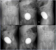 Image result for Voiding Cystourethrogram