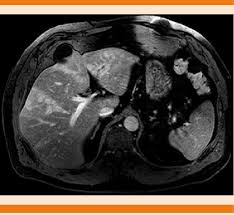 Indicates that the study sponsor or investigator recalled a submission of study results before quality control (qc) review took place. Resonancia Magnetica Nuclear Microabscesos Y Trombosis De La Rama Download Scientific Diagram